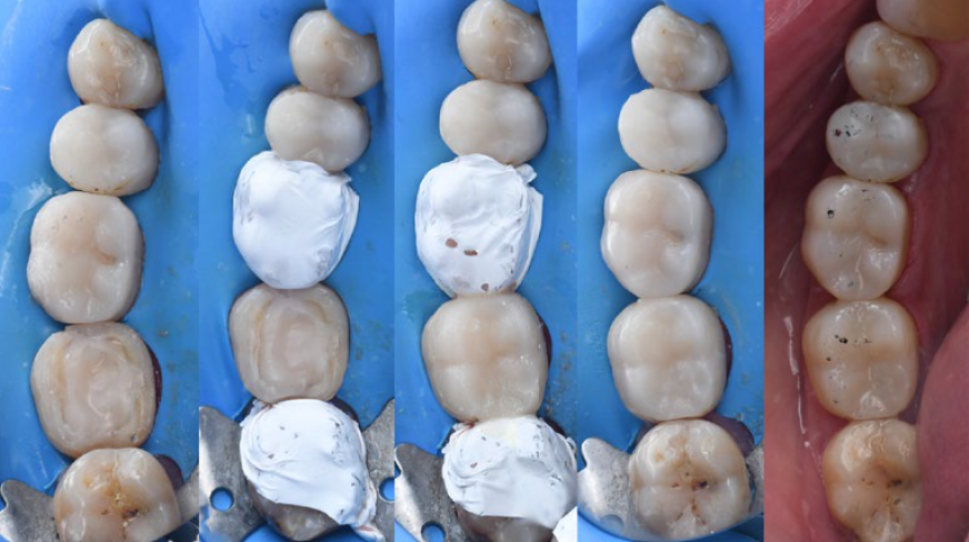 Fig. 5: Alternating approach: Restoration of the second molar by injecting flowable composite.